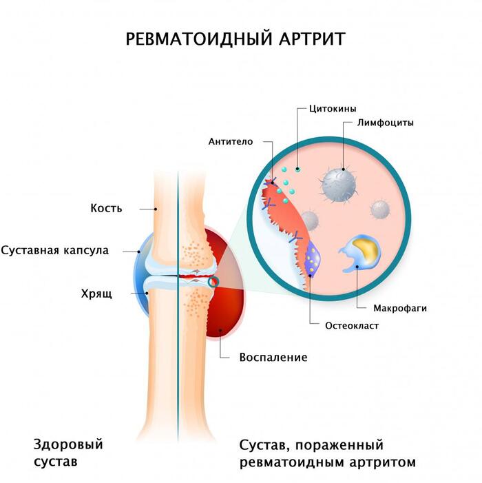 Ревматоидный артрит